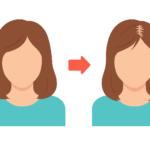 女性特有のびまん性脱毛症や分け目の薄さの特徴