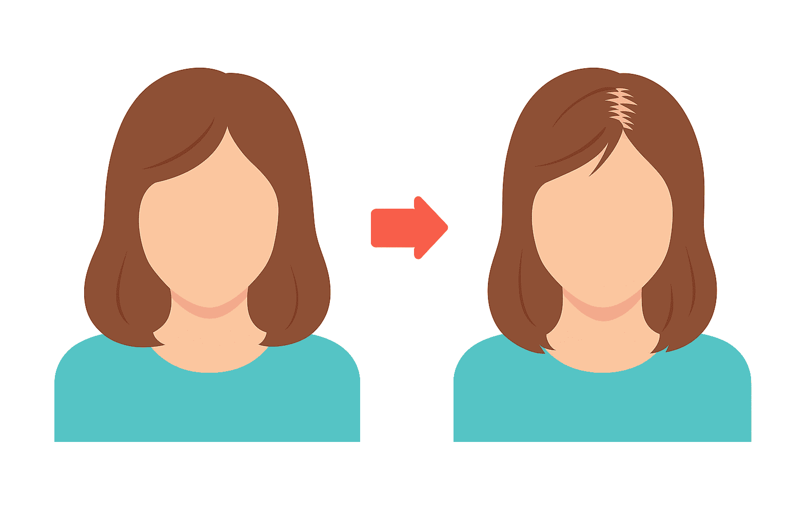 女性特有のびまん性脱毛症や分け目の薄さの特徴