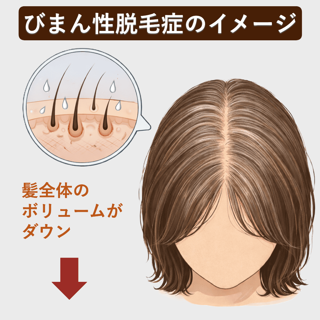 びまん性脱毛症のイメージ（髪全体のボリュームがダウン